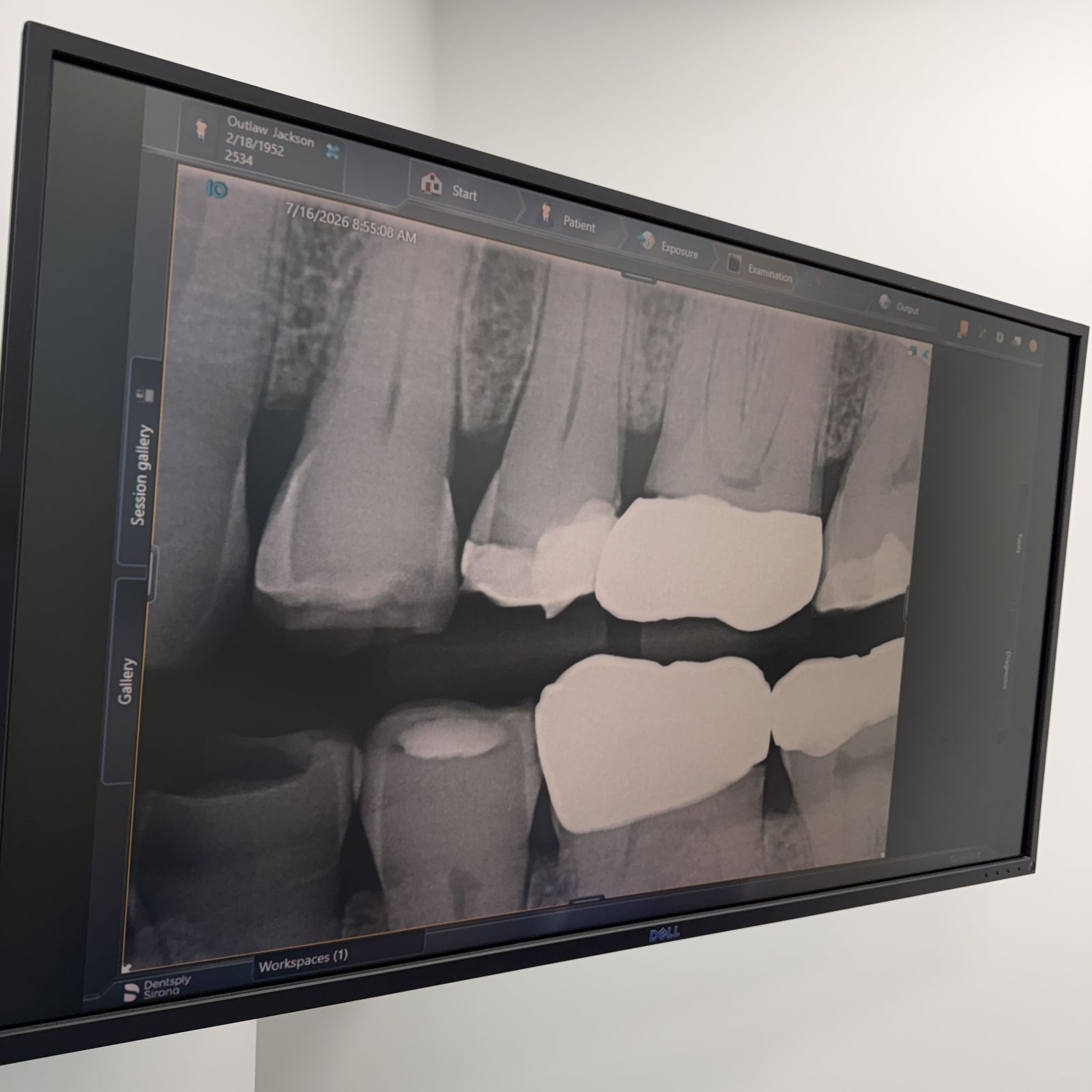 Digital dental X-ray displayed on the operatory screen